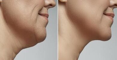 Double Chin Removal in Dubai